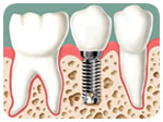 Implantes Dentários